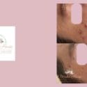 Amazing Results With Mabin’s Dermapen 4 Gold Needling Procedure.