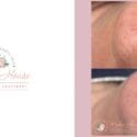 Impressive Results😱 With Mabin’s Candella Medical Vascular Laser Treatment.
